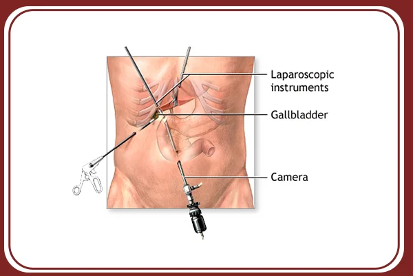 Gallbladder and Biliary Tree Surgery
