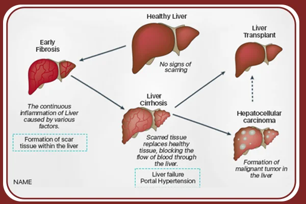 Tumors of Liver