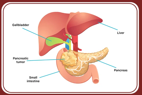 Pancreatitis and Pancreatic Tumors