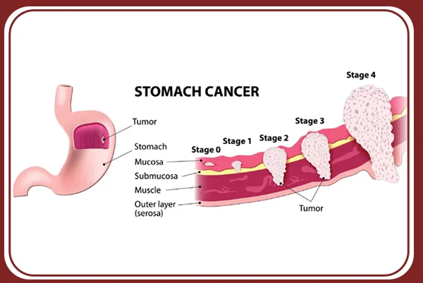 Stomach Cancer