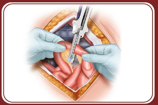Small and Large Intestine Surgery