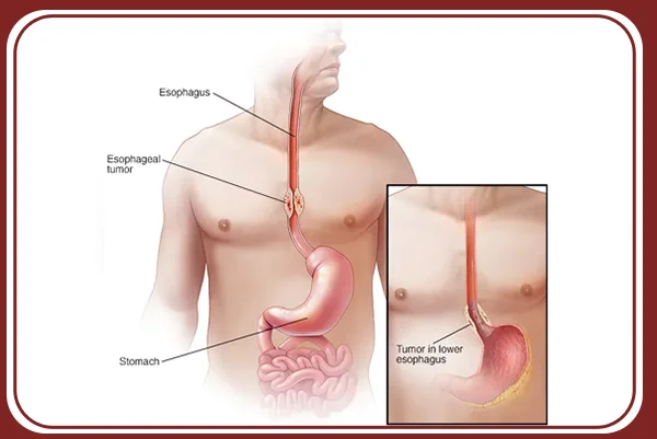 Esophagus Cancer and Other NonCancerous Disease