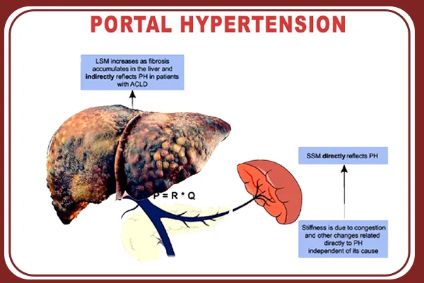 Portal Hypertension and Spleen Surgery